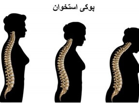 بیماری شایع پوکی استخوان در زنان و مردان